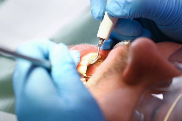 Best Emergency Root Canal Treatment in Liolnton, NC