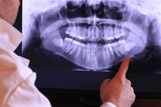 Best Emergency Dentist for Lost Fillings or Crowns in Liolnton, NC